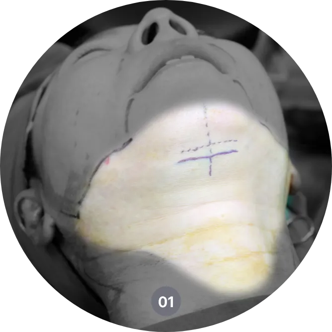 목거상술 방법 - 이중턱과 처진 목 라인을 개선하는 수술 과정