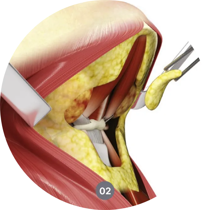 목거상술 방법 - 이중턱과 처진 목 라인을 개선하는 수술 과정