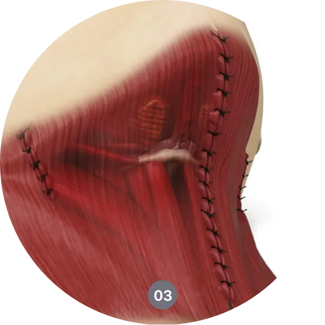 목거상술 방법 - 이중턱과 처진 목 라인을 개선하는 수술 과정