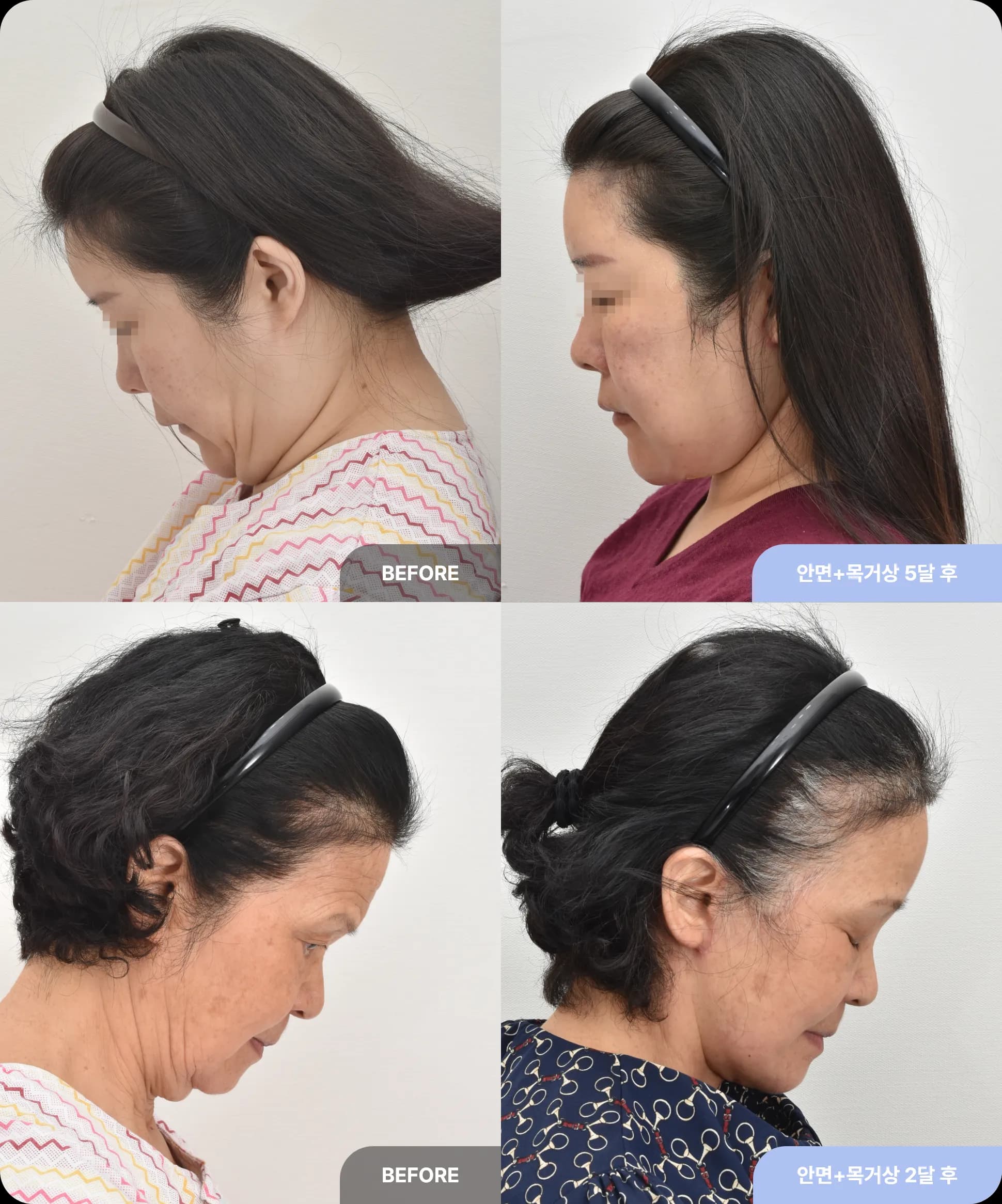 이중턱과 처진 피부를 해결하는 근육 묶기 수술 방법