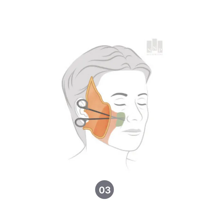 SMAS facelift procedure in Noonopi Plastic Surgery