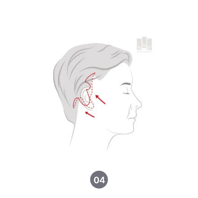 눈높이성형외과 안면거상술 방법 소개