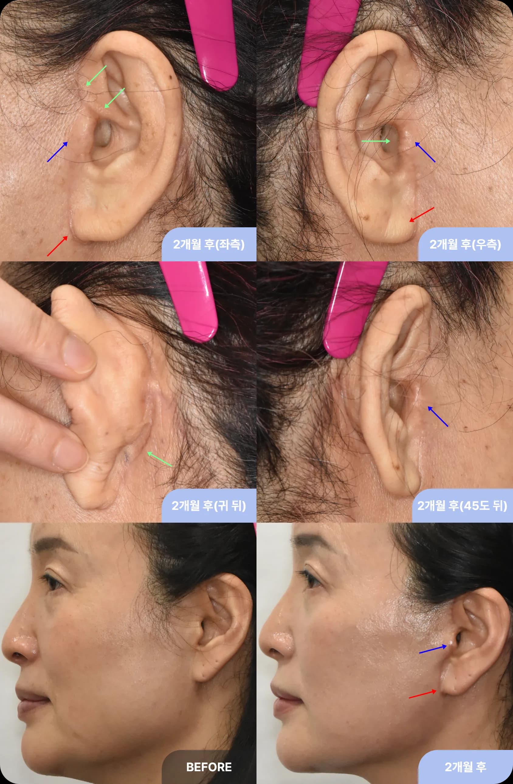 눈높이성형외과 안면거상의 4가지 특징 - 1. 찾기 힘든 흉터