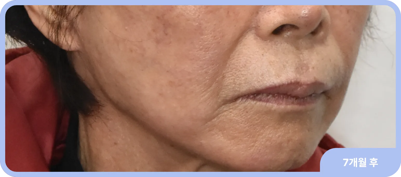 눈높이 성형외과 안면거상의 4가지 특징 - 3. 재수술 경험이 풍부