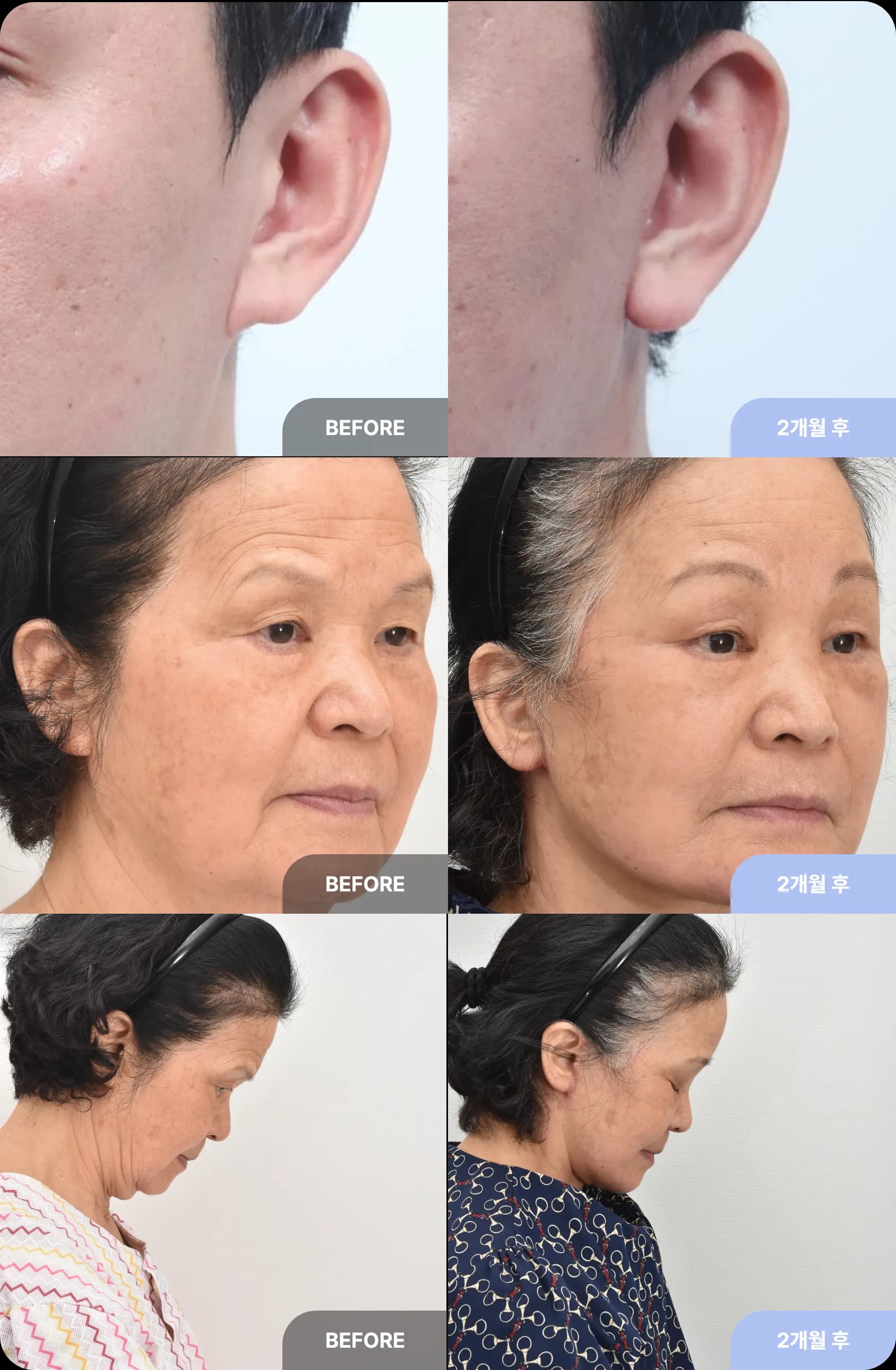 눈높이 성형외과 안면거상의 4가지 특징 - 4. 자연스러운 귓볼