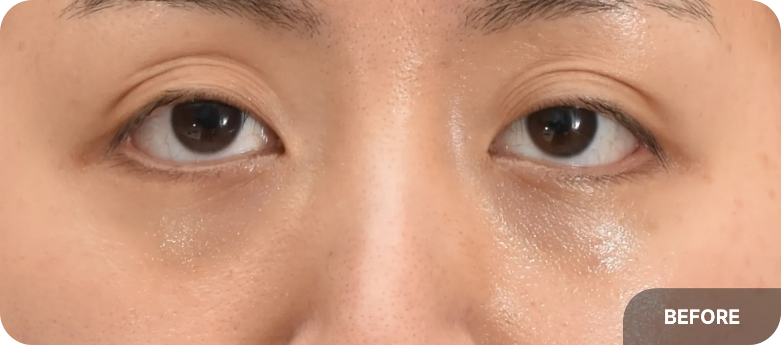 Before fat injection - noticeable upper lid hollowness and volume loss