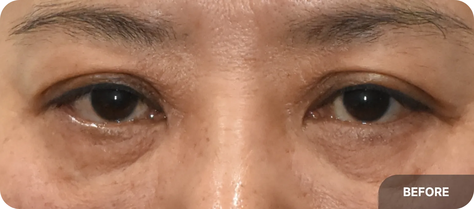 Complication of overdone lower blepharoplasty - severe depression under eyes