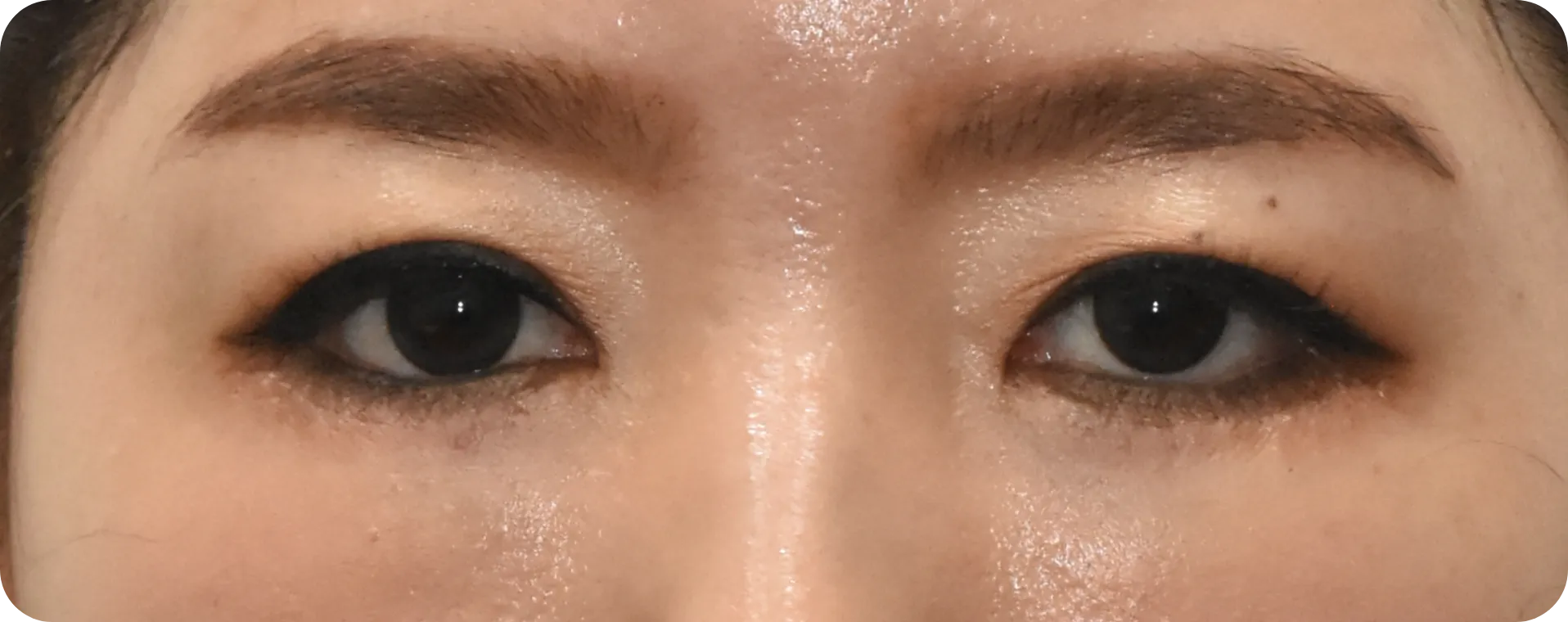 more youthful and smooth lower lid after eyelid fat graft