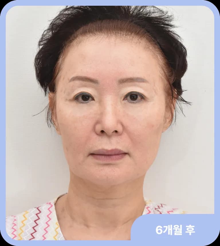 얼굴지방이식 후 자연스럽게 개선된 얼굴 윤곽과 피부 탄력