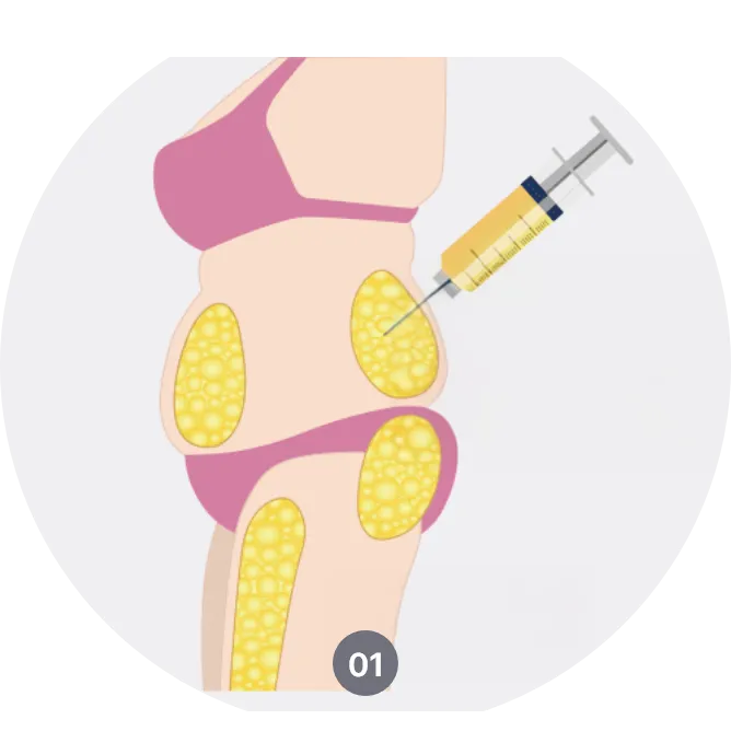 지방이식-수술법