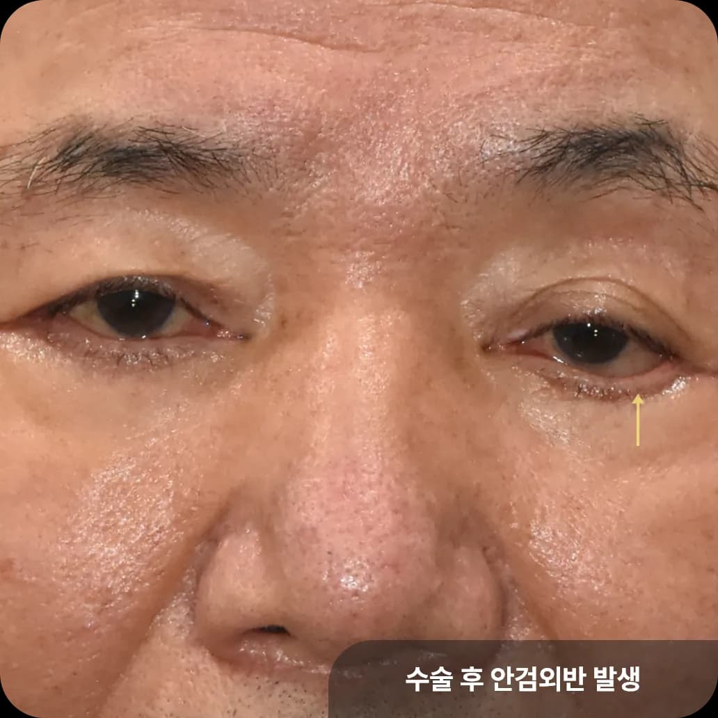 하안검성형 합병증으로 한쪽 눈꺼풀 뒤집어짐이 발생