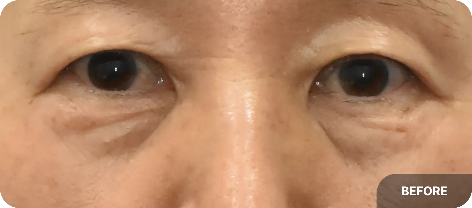 Lower eyelid aging - wrinkles and eyebags causing tired appearance