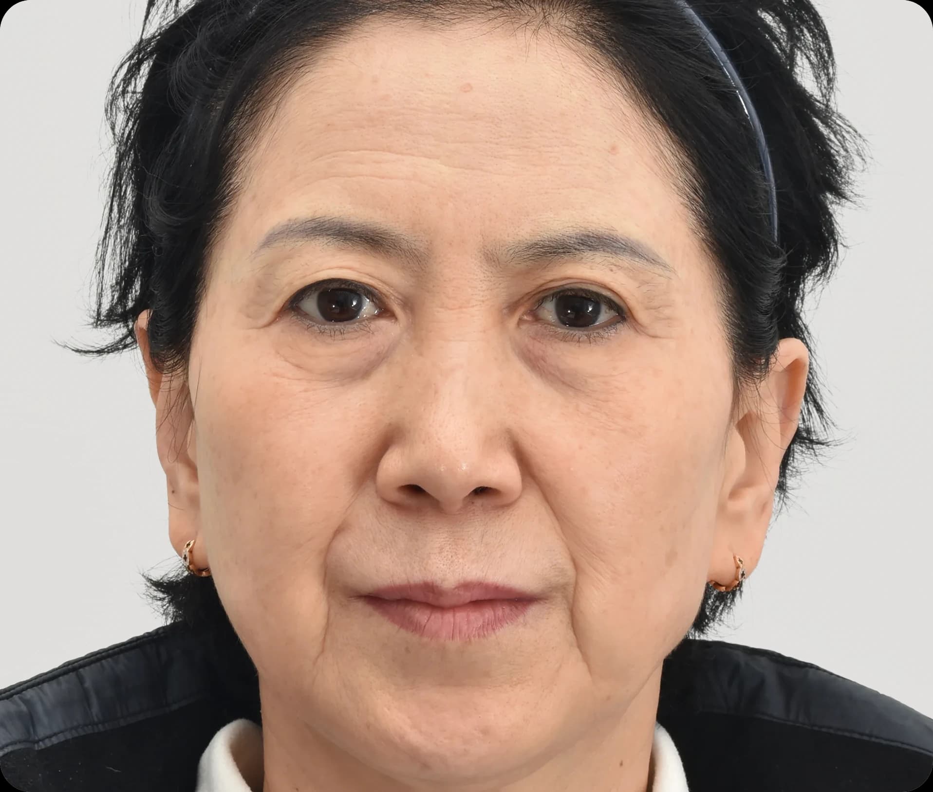 Before lower blepharoplasty - under-eye wrinkles and eyebags
