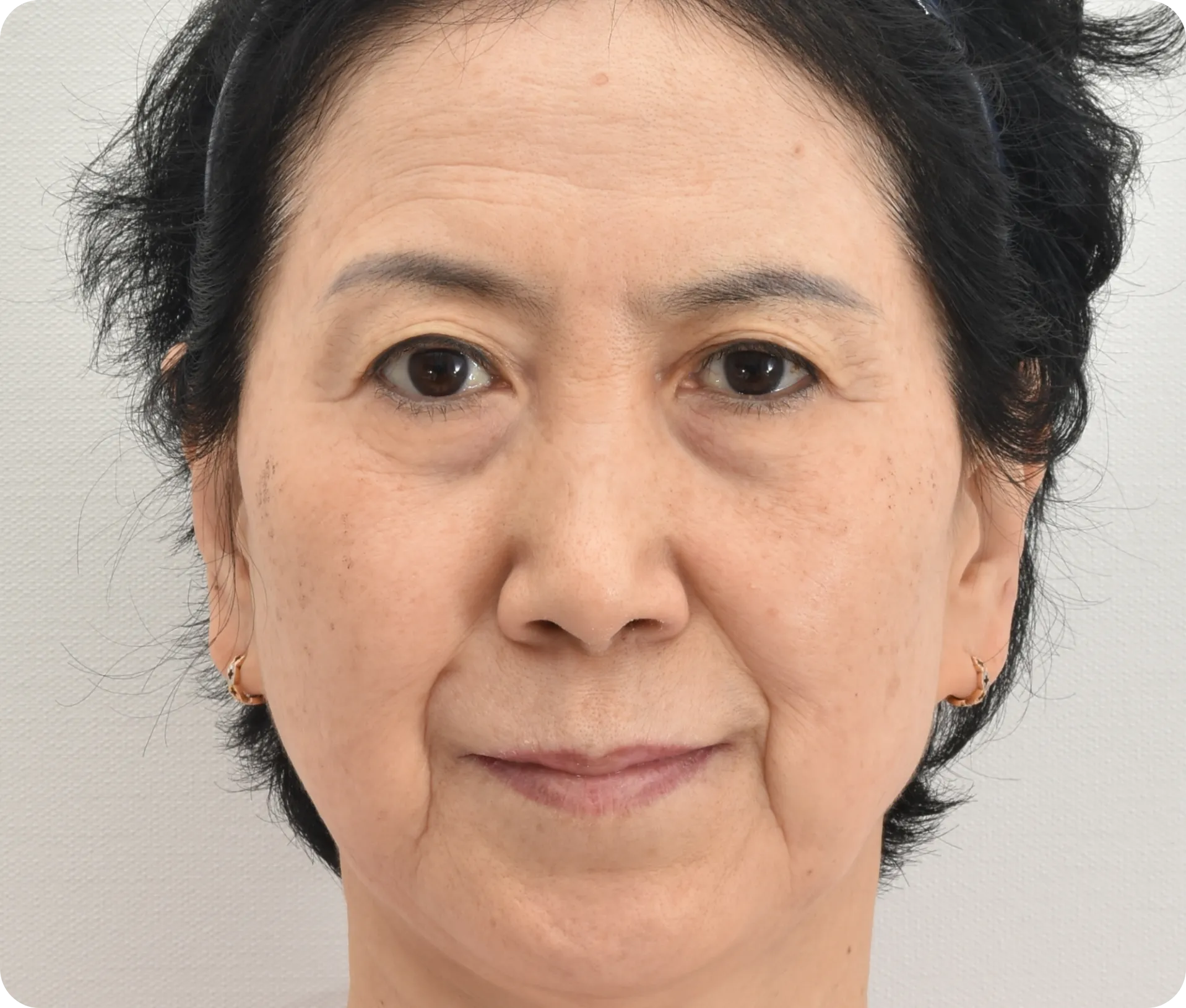 눈 밑 꺼짐이 심한 60대 여성 - 하안검 및 지방이식 수술 전 모습