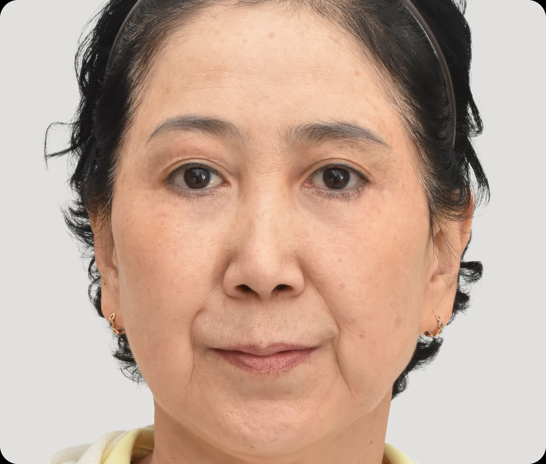 After lower eyelid lift - depression and wrinkles are corrected