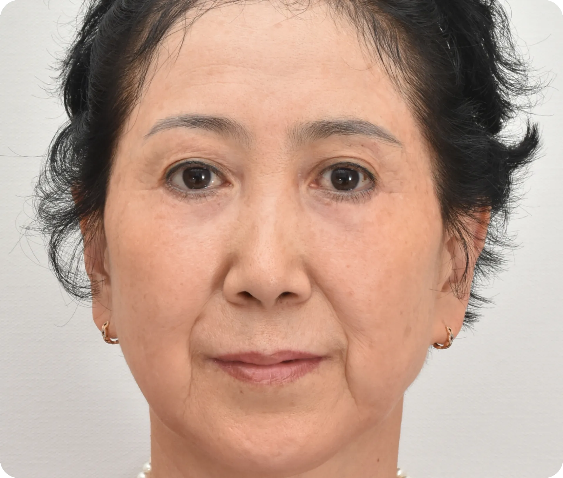 After lower eyelid lift - depression and wrinkles are corrected