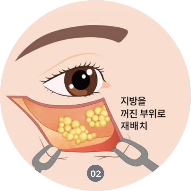 하안검수술 절개위치와 지방 재배치 방법 안내