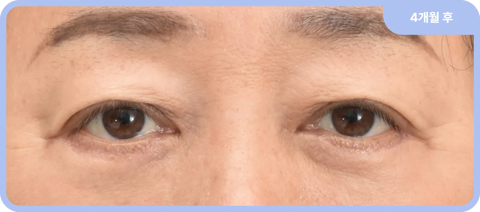 눈 밑 지방 돌출 교정 및 피부 탄력 개선 - 하안검 수술 후 변화