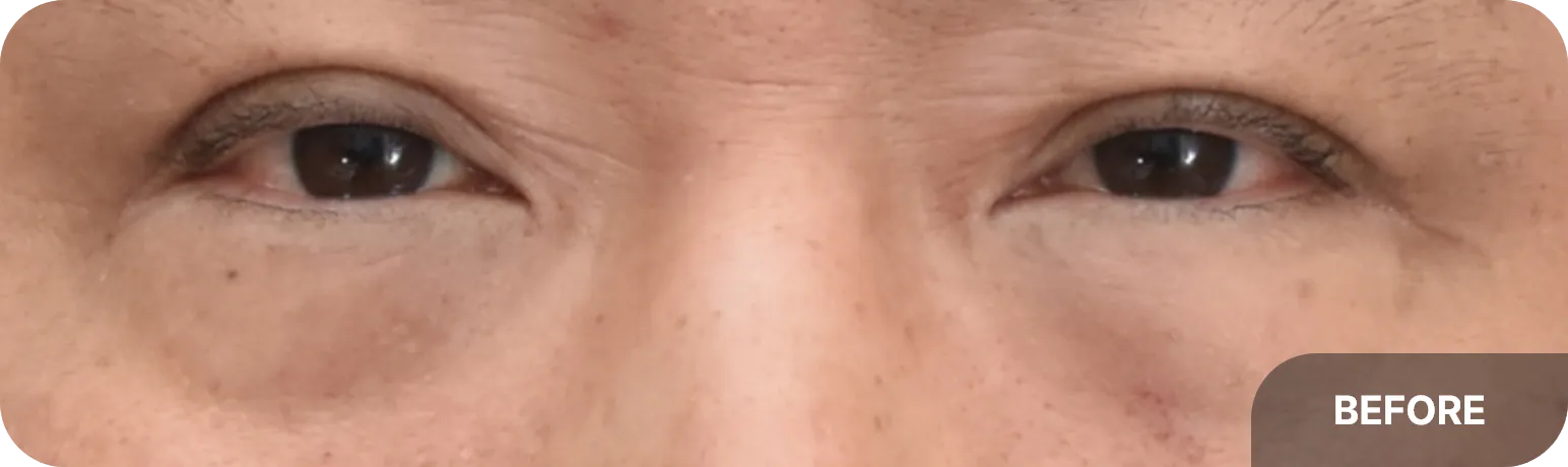 Even in the 50s, effective results can be achieved if skin hooding is minimal