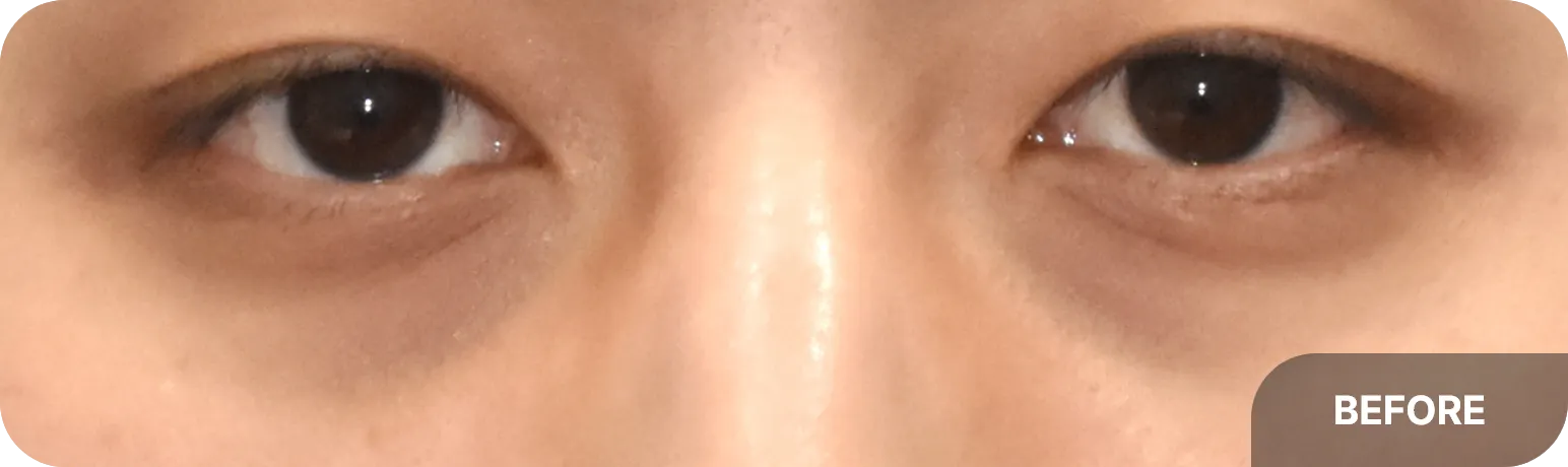 Before treatment for dark circles - tired and fatigued under-eye appearance