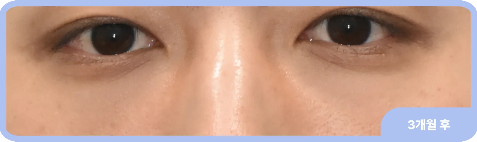 수술 후 다크서클 관리를 위해 레이저 및 토닝 치료로 효과를 극대화한 사례