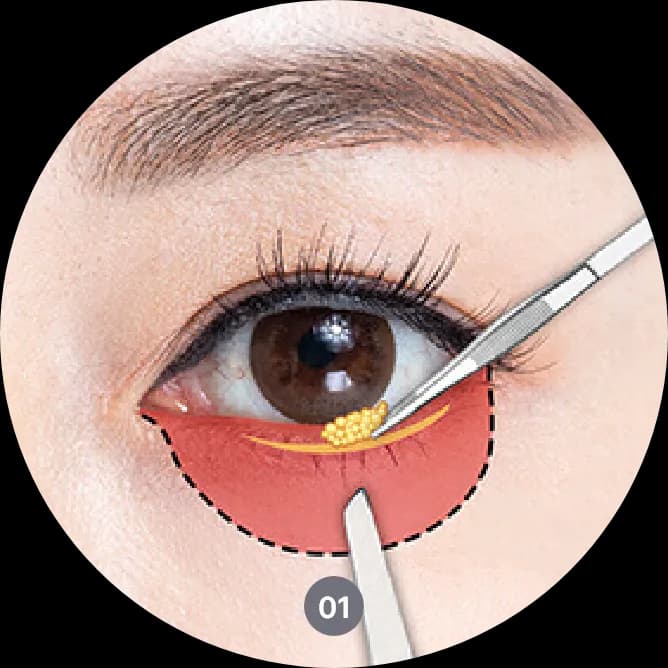 procedures of scar free lower blepharoplasty in korea