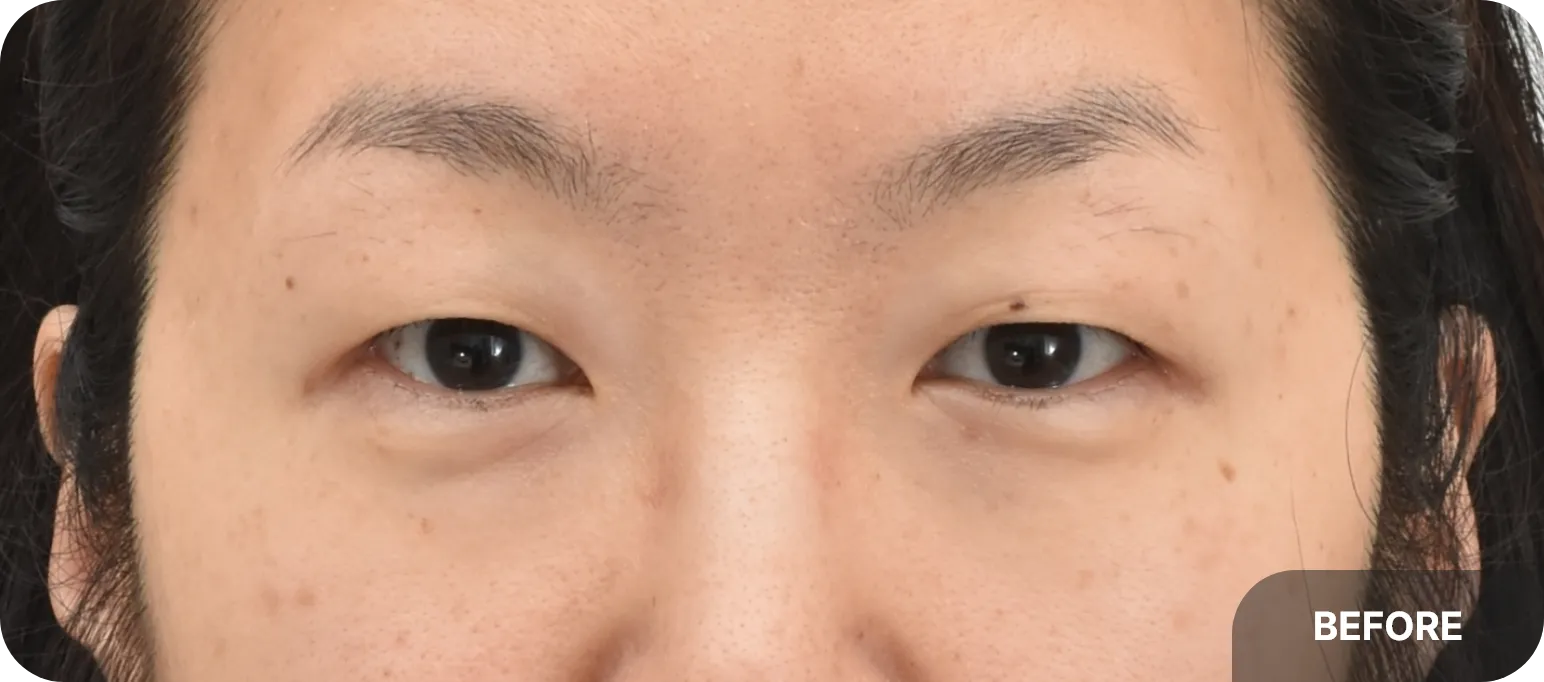 40대 여성 상안검 수술 전 모습 - 처진 눈꺼풀로 인해 눈이 답답해 보이는 상태