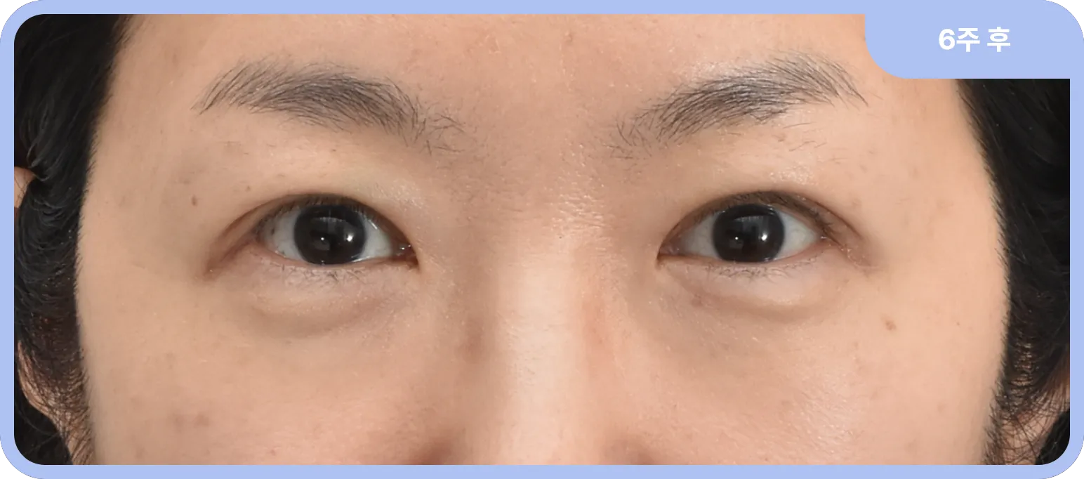 상안검 수술 후 40대 여성 - 자연스럽고 생기 있는 눈매 변화