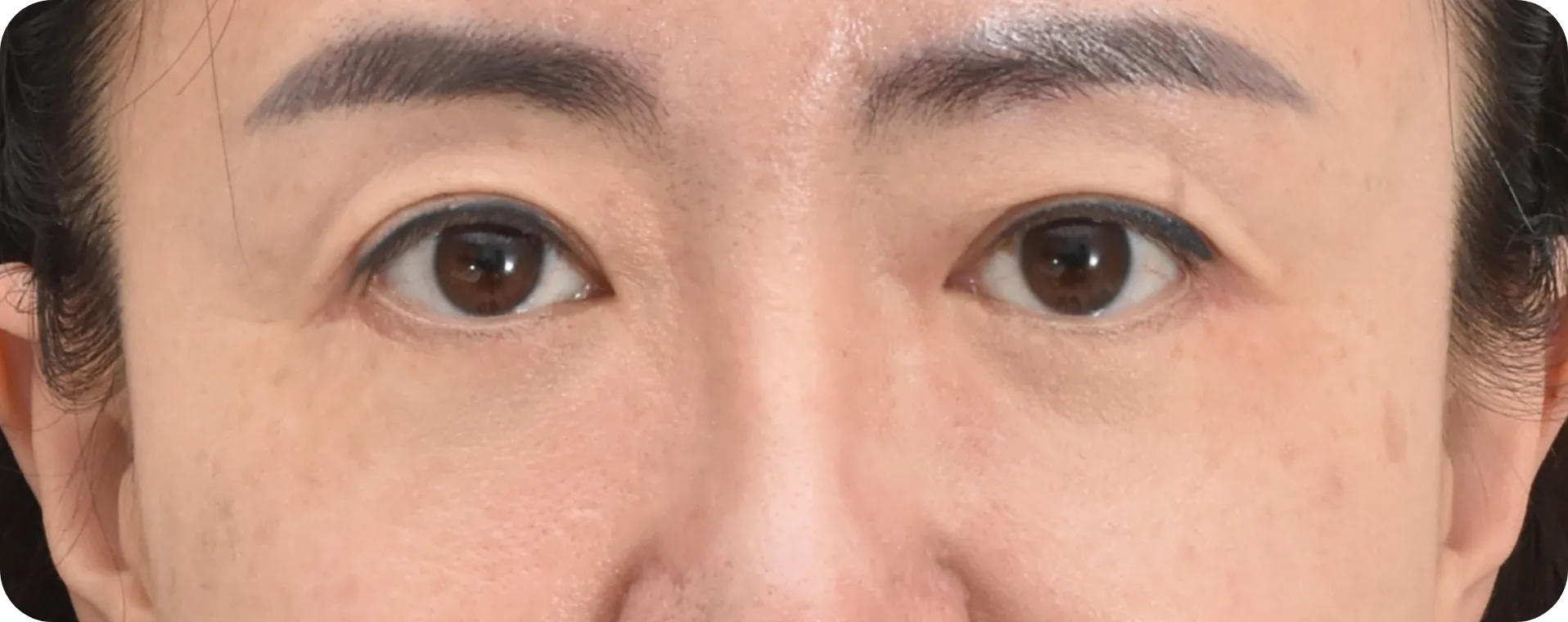상안검 수술 후 젊어진 눈매 - 처진 눈꺼풀 개선 효과