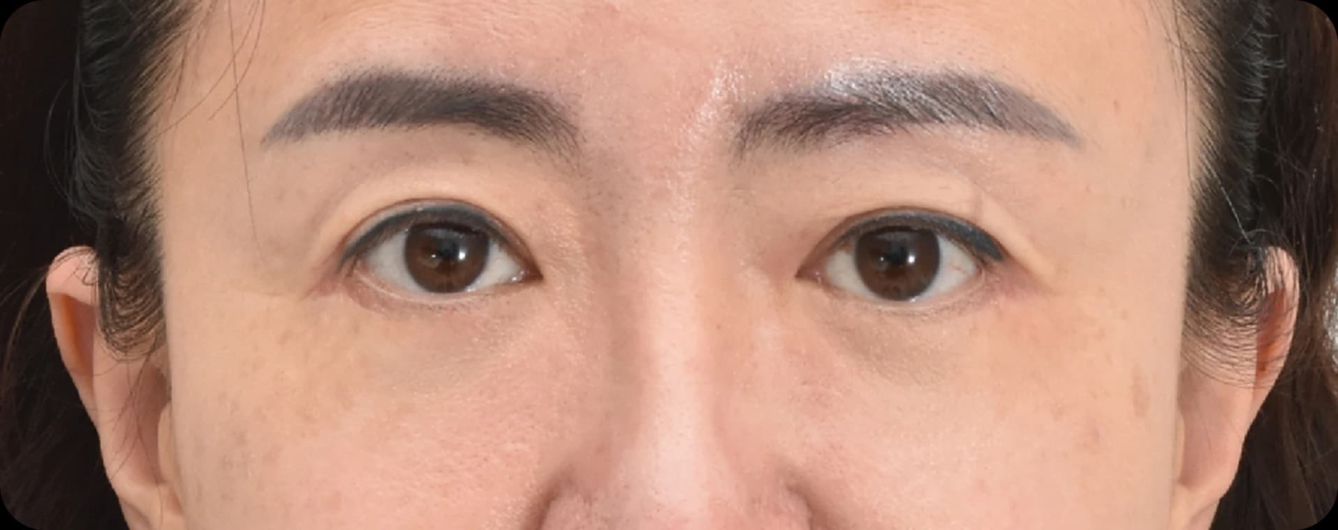 상안검 수술 후 젊어진 눈매 - 처진 눈꺼풀 개선 효과