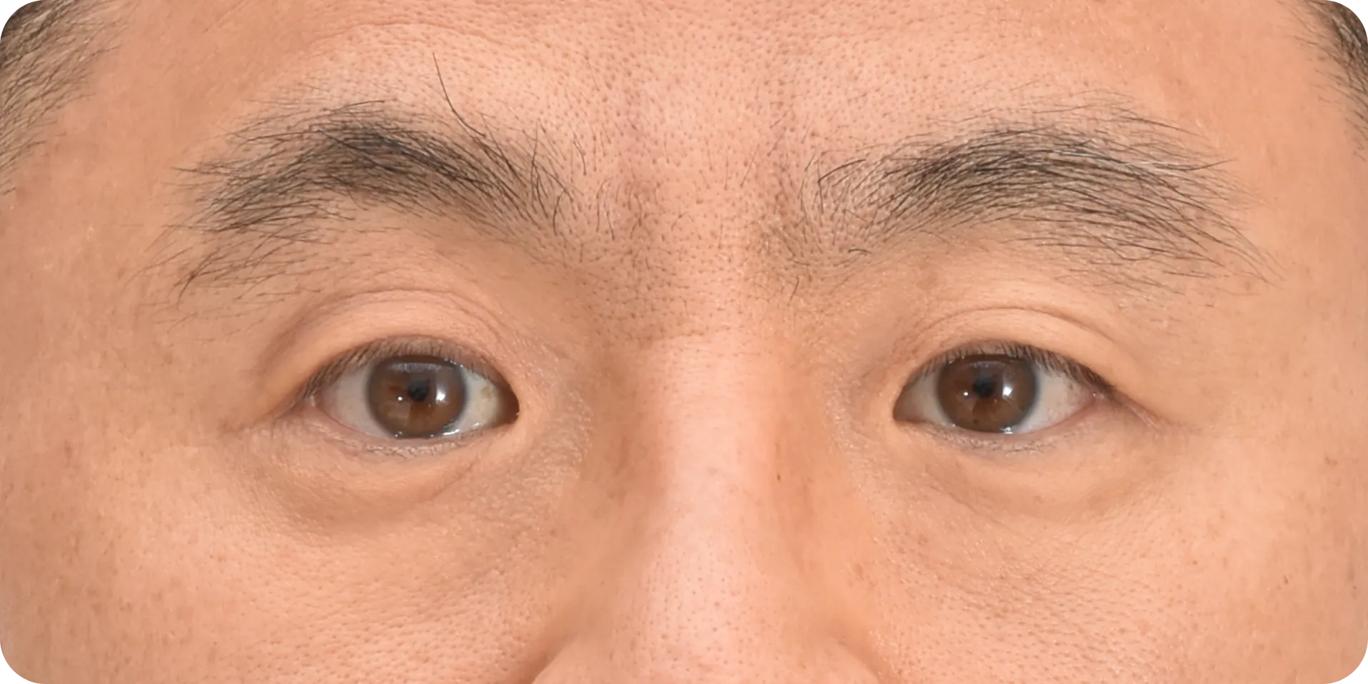 미간주름 레이저