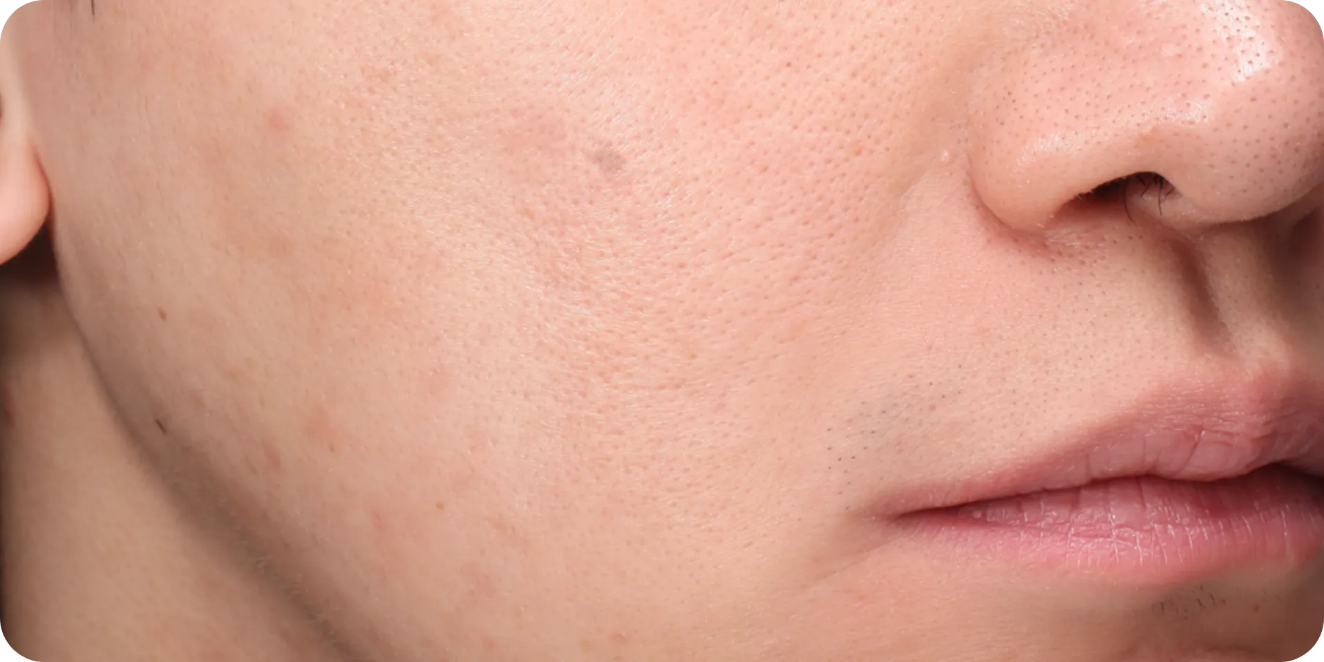 pores laser treatment gangnam