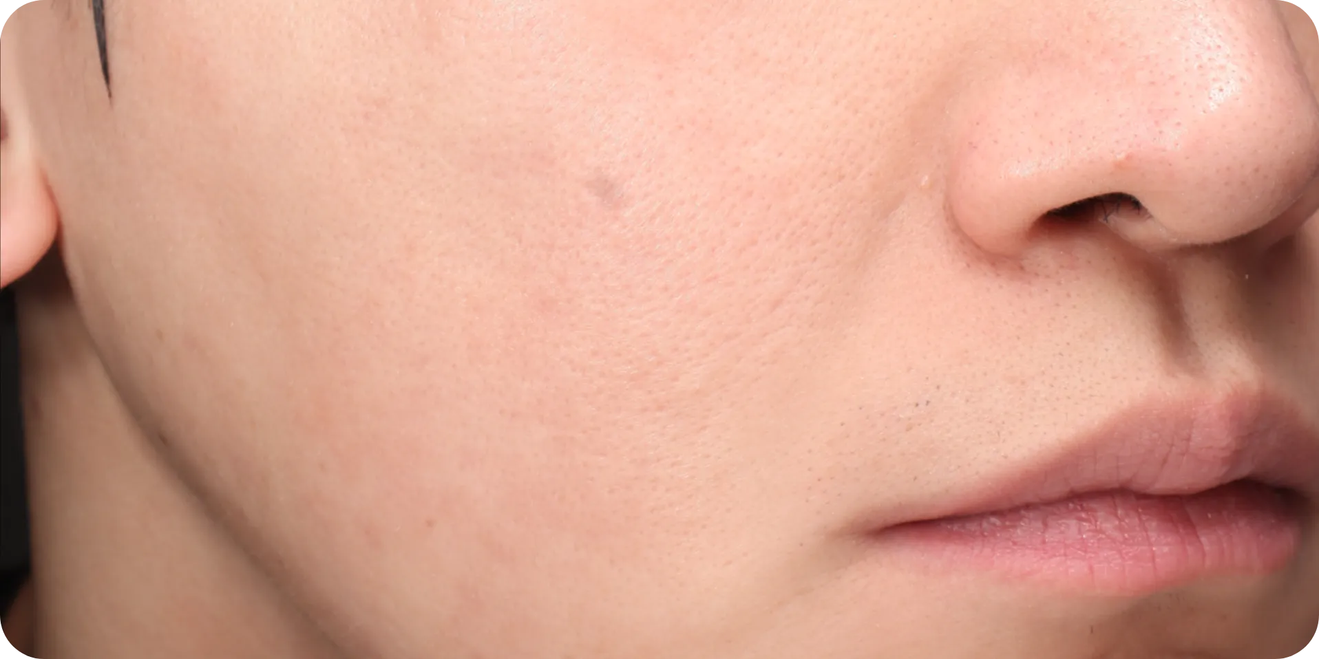 pores laser treatment gangnam