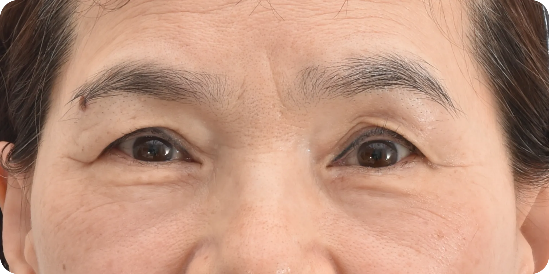 glabellar wrinkles treatment - before