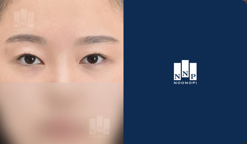 쌍꺼풀 눈매교정 뒤밑트임