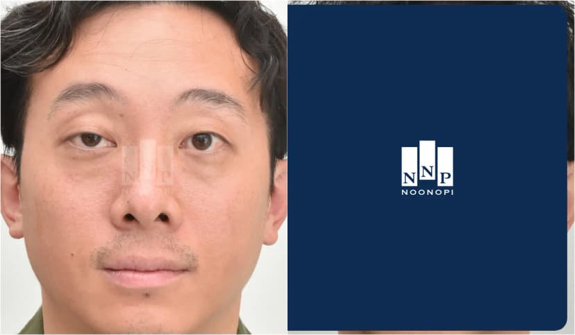 짝눈교정, 하안검