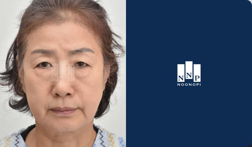 이마거상, 하안검, 눈썹하거상