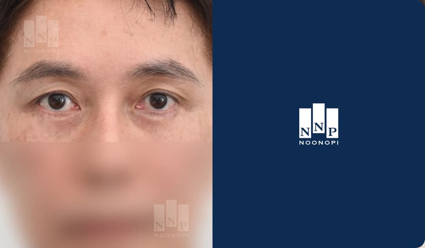 다크서클 패키지, 애교 지방이식