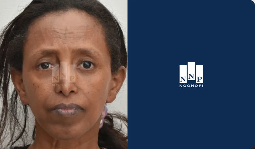 안면거상재수술, 목거상, 이마거상, 하안검, 지방이식