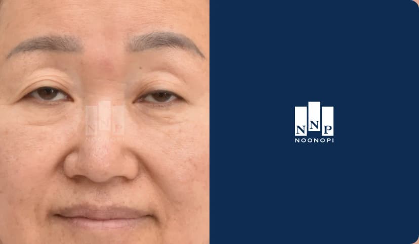 안검하수로 인한 짝눈교정