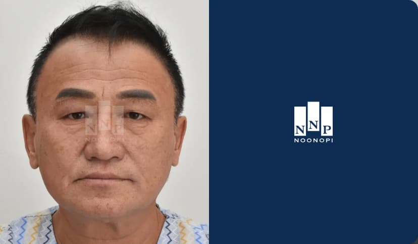 매몰, 눈썹하거상, 이마거상, 하안검, 이마 주름레이저