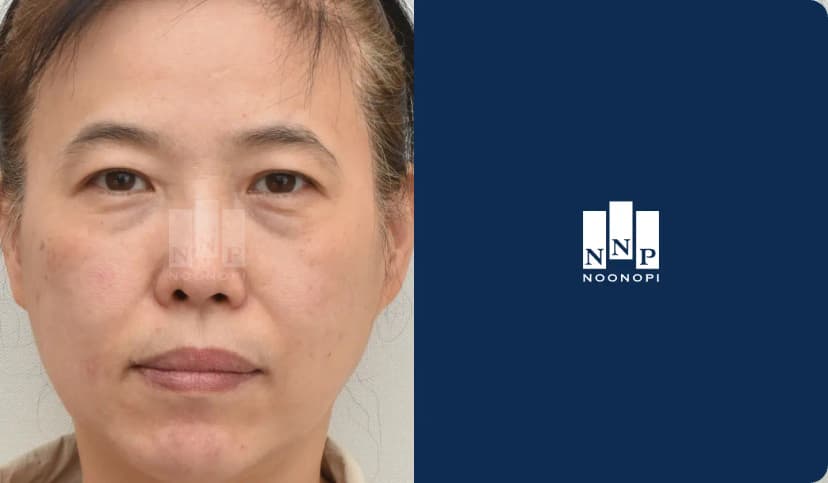 눈밑지방재배치