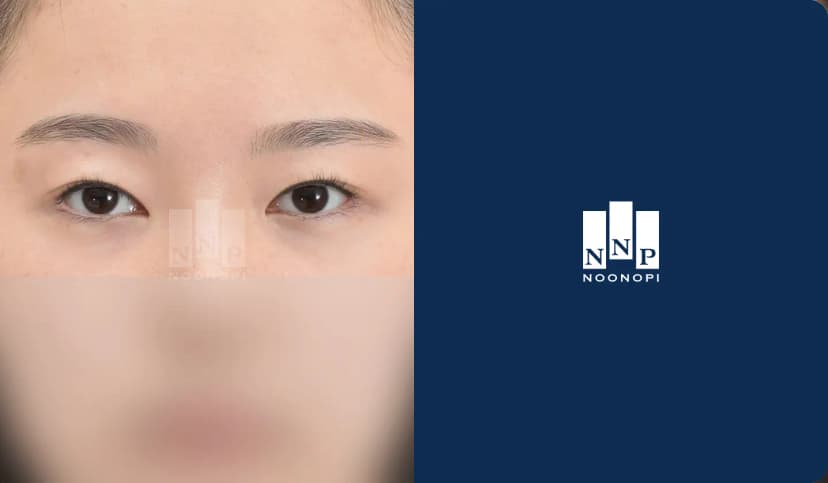쌍꺼풀 눈매교정 뒤밑트임