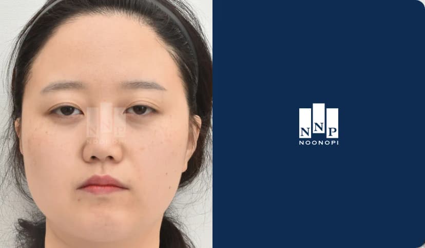 절개 쌍꺼풀, 눈매교정, 앞트임