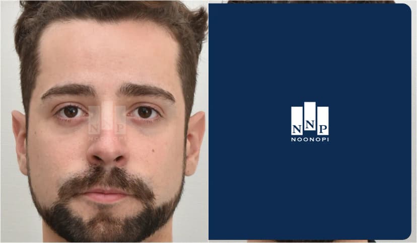 눈꼬리리프팅, 눈밑 지방이식